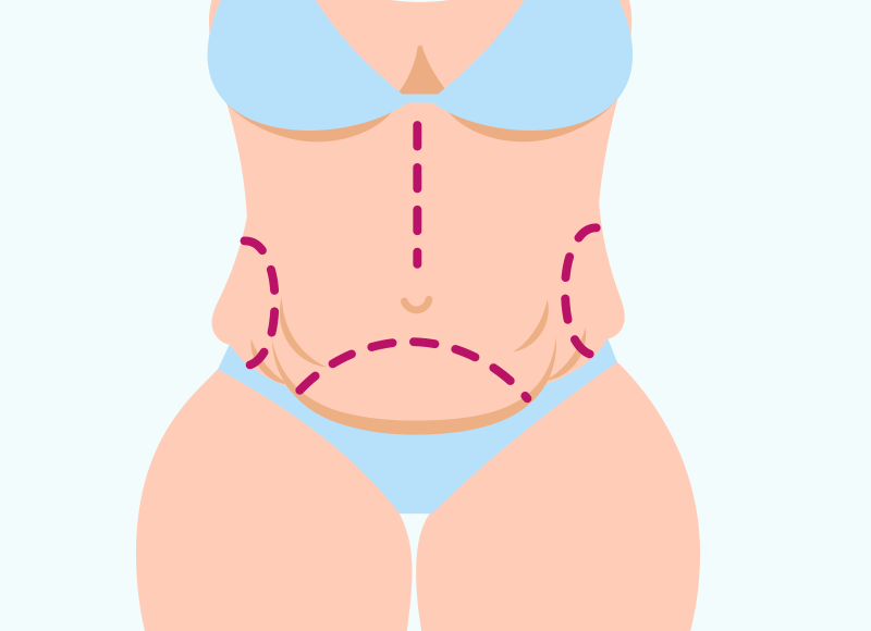 Cirurgia para o Abdômen