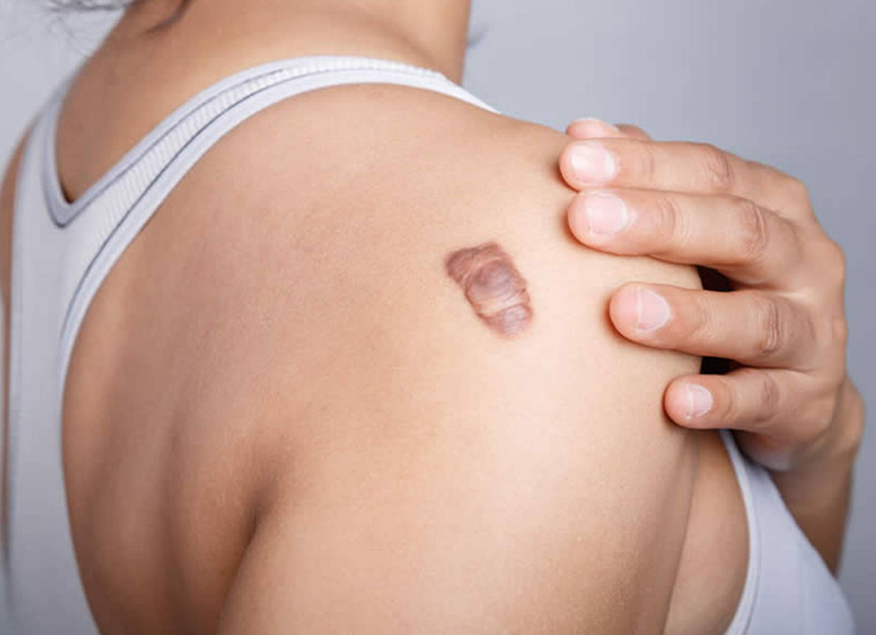 Imagem de uma mulher banca com uma queloide na parte de trás do seu ombro direito.