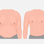 Ilustração do peitoral de um homem antes e depois da cirurgia.