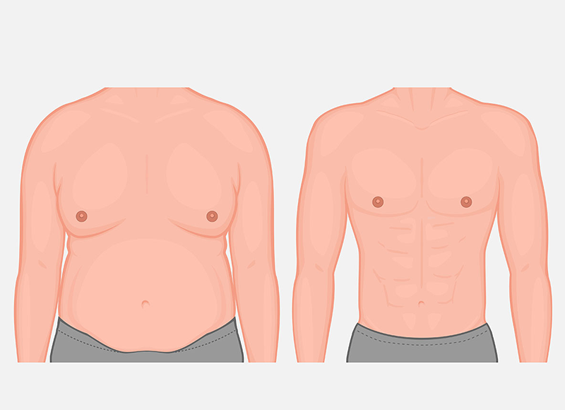 Ilustração do peitoral de um homem antes e depois da cirurgia.