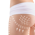 Imagem de um glúteo feminino com demarcações para cirurgia.