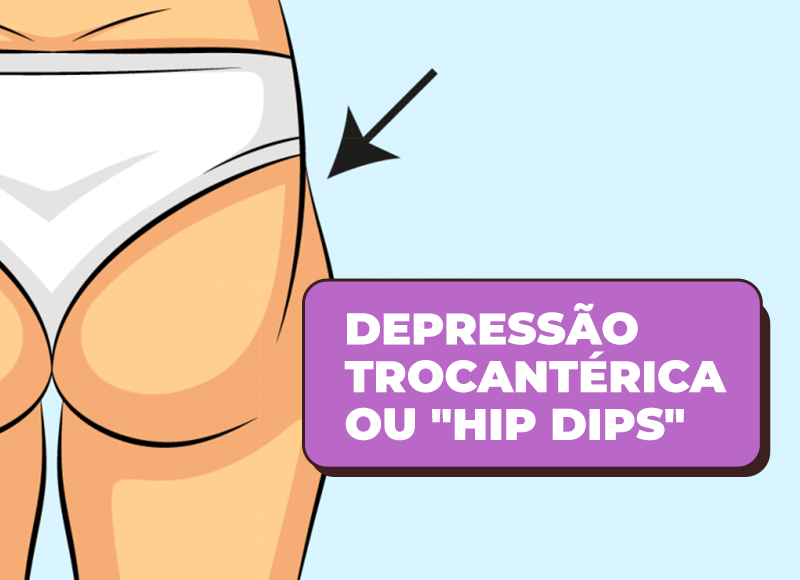 Locatelli Fit - 🏋️‍♀️ Depressão trocantérica ou Hip dips