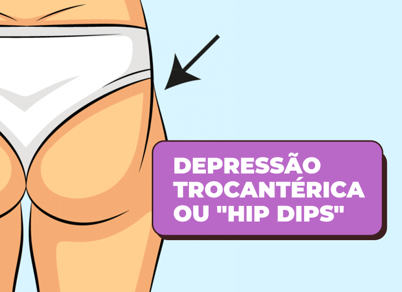 Depressão trocantérica, ou Hip Dips: entenda o que é isso - Alexandre  Kataoka